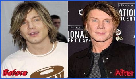 John Rzeznik Facelift | Goo Goo Dolls Frontman Plastic Surgery Before And After